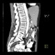 Nutcracker syndrome, aortomesenteric compression: CT - Computed tomography